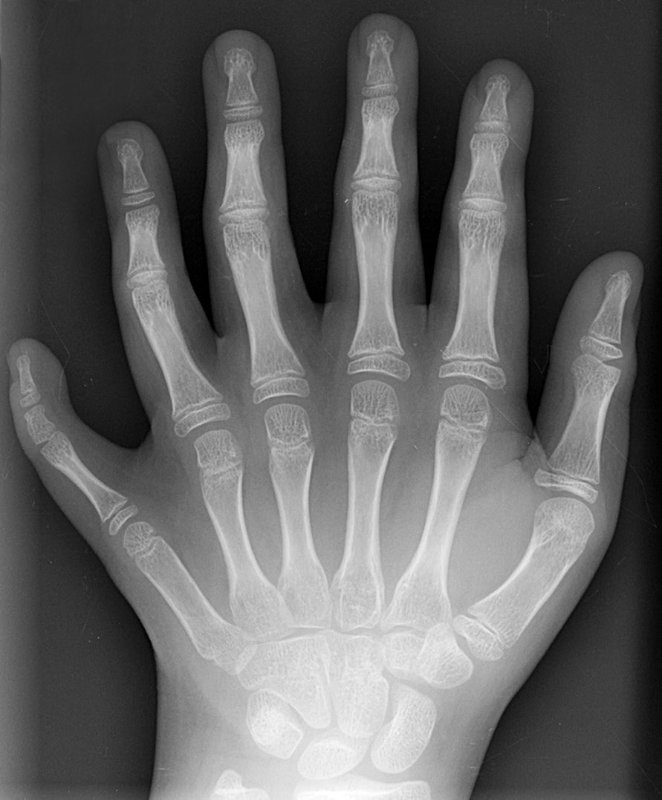 Polydactyly F Liszt a067 Beyreuth.jpg