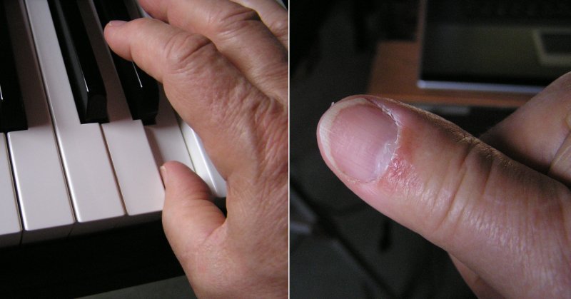 mon pouce mattraqué.jpg